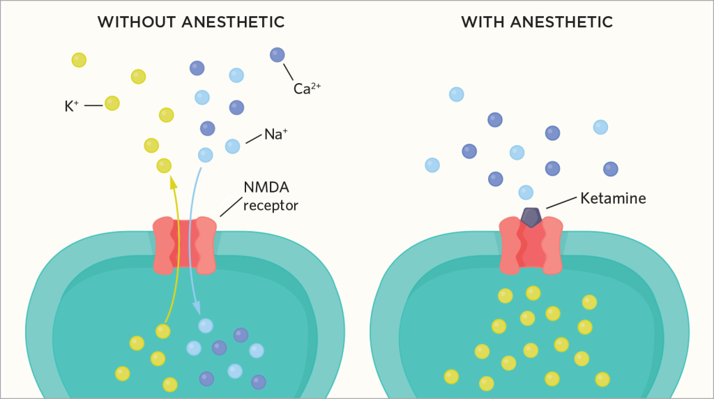 Diagram comparing synaptic activity without anesthetic and with ketamine. Left side shows ions (K+, Ca2+, Na+) interacting with NMDA receptor. Right side, akin to Matthew Perry's journey, shows ketamine blocking the receptor, preventing ion flow. - Ketamine